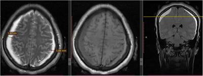 Bilateral abducens nerve palsy from post-spinal-anesthesia-induced bilateral chronic subdural hematoma: case report